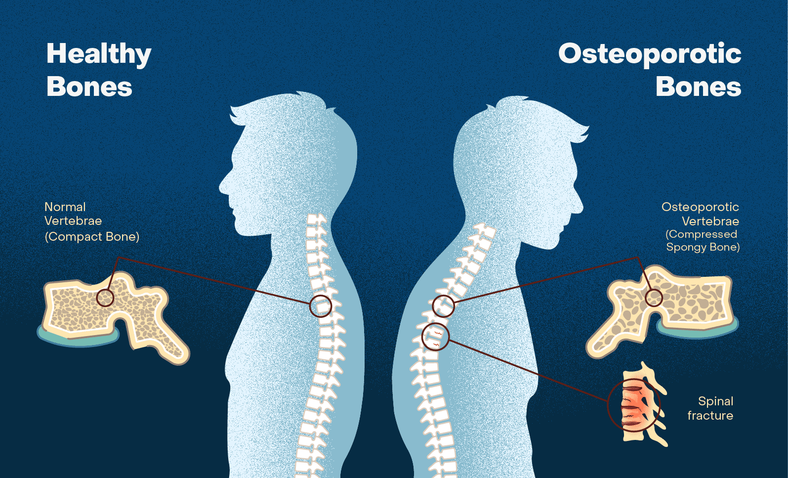 Ilustrasi Osteoporosis